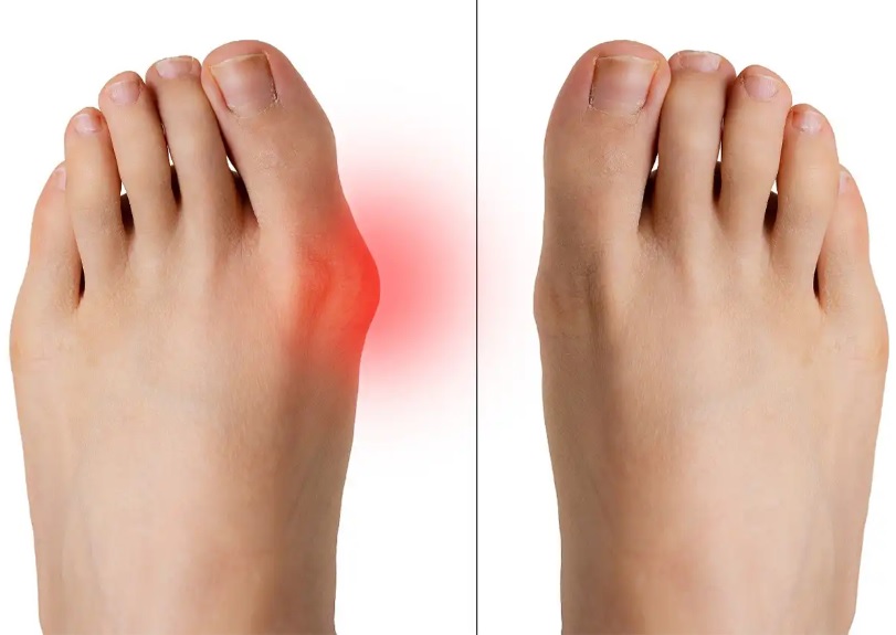 Հալուքս-վալգուսի բուժում